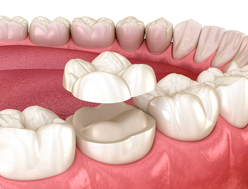Restauração dentária